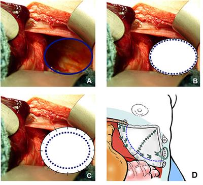 Longitudinal Follow-Up With Radiologic Screening for Recurrence and Secondary Hiatal Hernia in Neonates With Open Repair of Congenital Diaphragmatic Hernia—A Large Prospective, Observational Cohort Study at One Referral Center